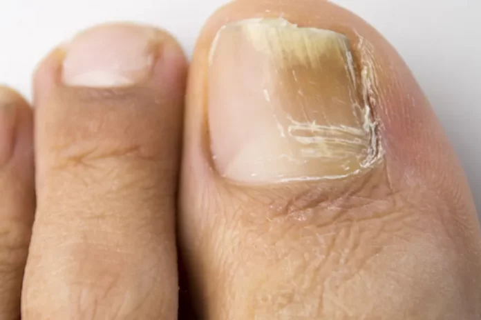 How to get rid of toenail fungus?