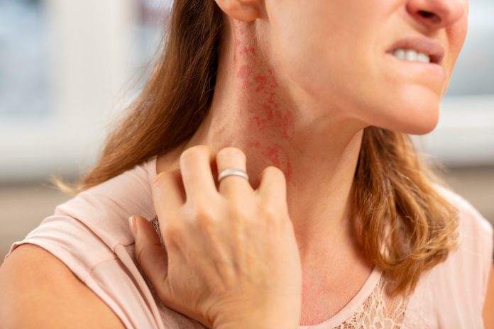 How to get rid of a rash?